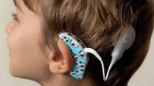 implante coclear